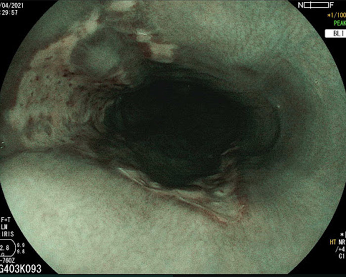 Hình ảnh nội soi thực quản có thể thấy các ổ loét (Hình 3)