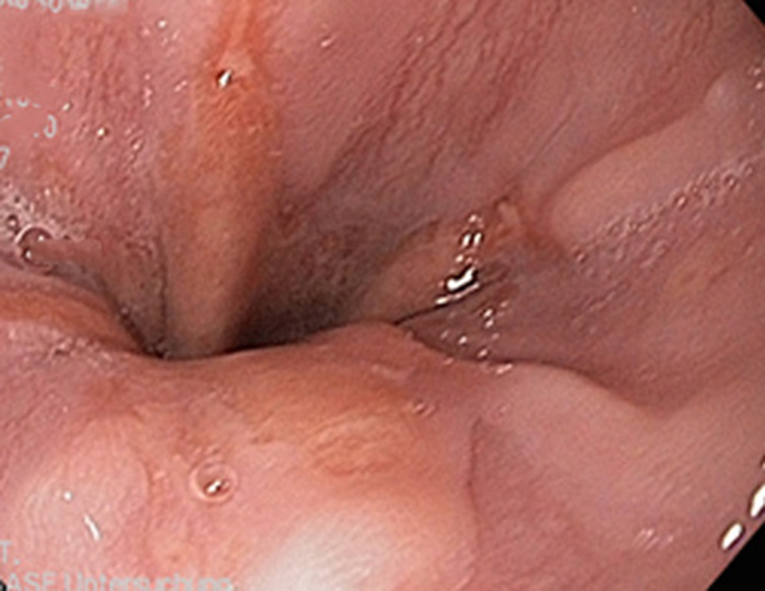 Hình ảnh nội soi viêm thực quản trào ngược (Hình 2)