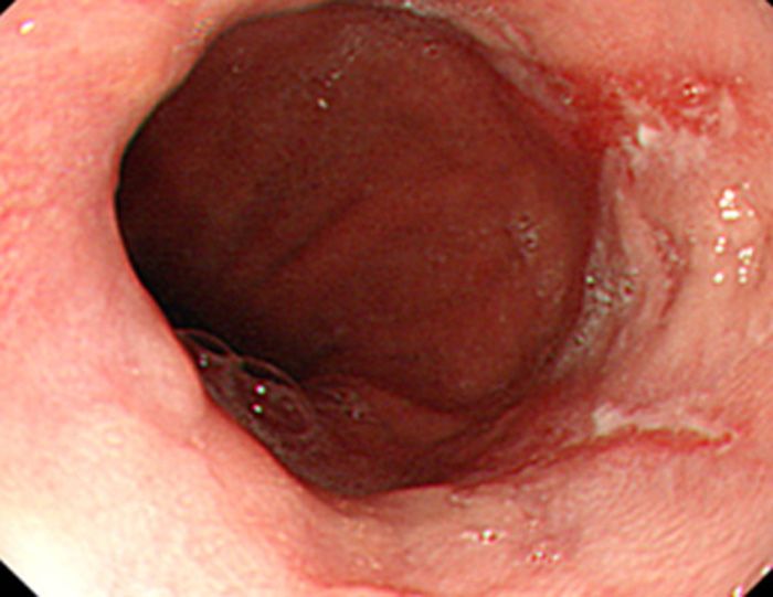 Hình ảnh nội soi viêm thực quản trào ngược (Hình 3)