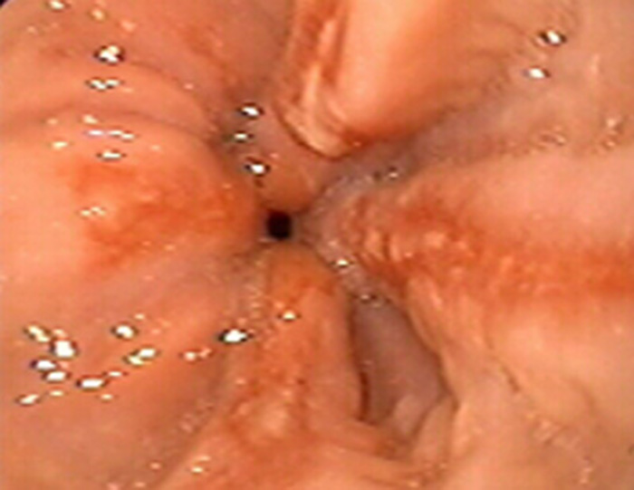Hình ảnh nội sọi viêm thực quản trào ngượcn LA độ B (Hình 1)