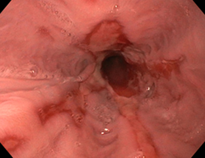 Hình ảnh nội sọi viêm thực quản trào ngượcn LA độ D (Hình 1)