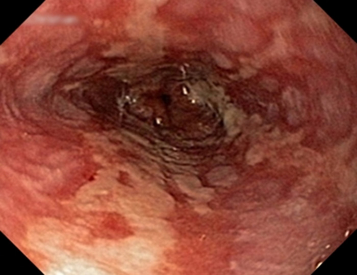Hình ảnh nội sọi viêm thực quản trào ngượcn LA độ D (Hình 2)
