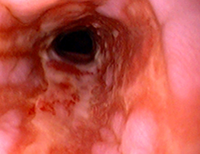 Hình ảnh nội sọi viêm thực quản trào ngượcn LA độ D (Hình 3)