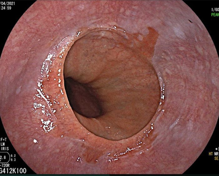 Hình ảnh nội sọi viêm thực quản trào ngượcn LA độ D (Hình 4)