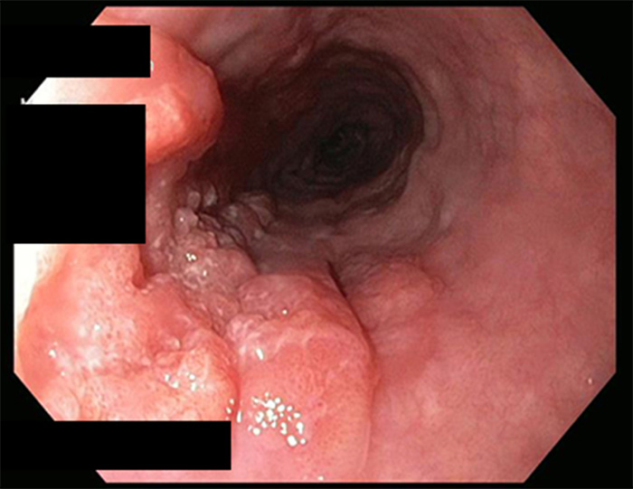 Hình ảnh ung thư thực quản type I: gồ cao ( phần thông tin cá nhân của bệnh nhân được che để đảm bảo tính riêng tư )
