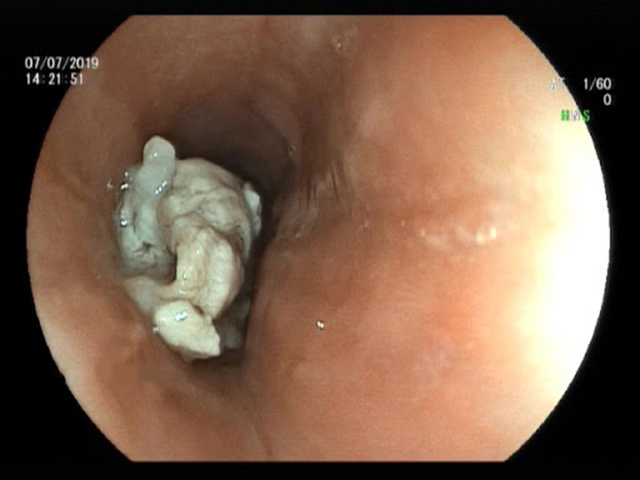 Thức ăn là dị vật thường bị mắc kẹt trong thực quản
