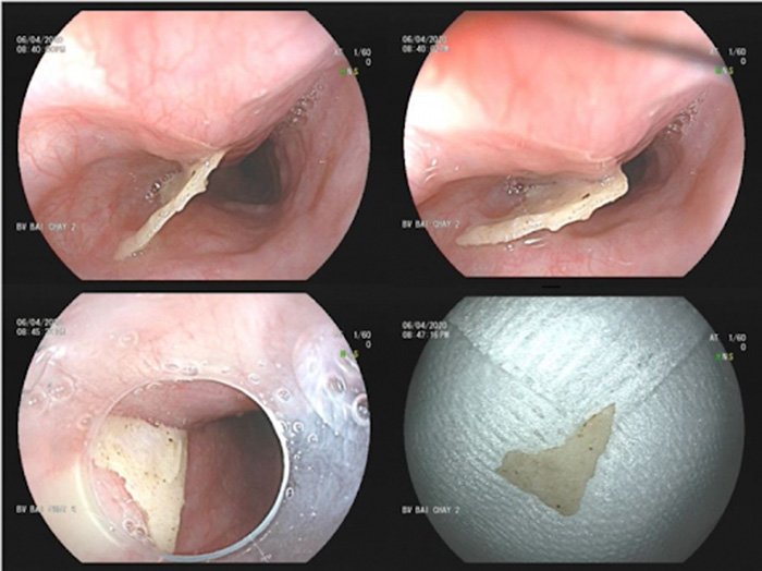 Hình ảnh nội soi mảnh xương vịt trong thực quản bệnh nhân
