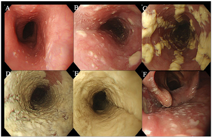 Hình ảnh nội soi nấm thực quản theo phân độ của Kodsi. 