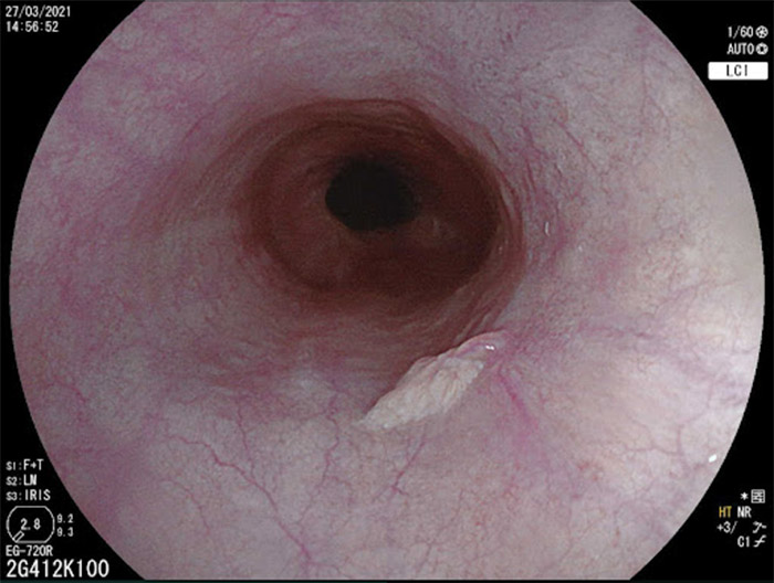 Hình ảnh nội soi thực quản lâm sàng thực tế (Hình 5)