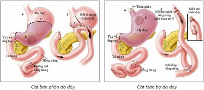 Phẫu thuật dạ dày có thể cắt bỏ một phần hoặc toàn bộ khiến cho kích thước dạ dày nhỏ đi