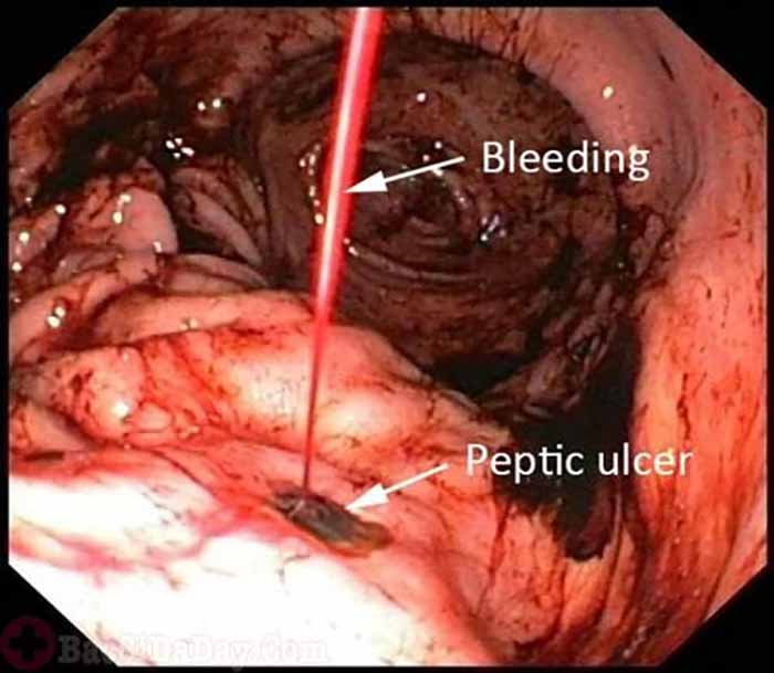 Hình ảnh loét dạ dày gây chảy máu ( Forrest Ia): máu chảy thành tia, là một trong các trường hợp cần cấp cứu.