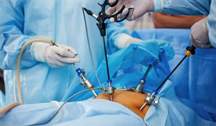 Mổ nội soi dạ dày là một trong 2 hình thức phẫu thuật dạ dày được ứng dụng trong y học hiện đại ngày nay.