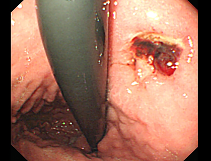 Hình ảnh loét dạ dày  ( Forrest IIb): ổ loét máu đã cầm được phủ bởi cục máu đông