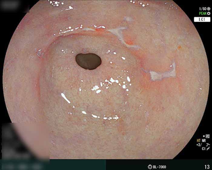 Hình ảnh loét dạ dày: các ổ loét có đáy phủ giả mạc trắng