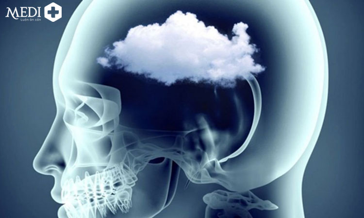 Sương mù não là di chứng hậu COVID có thể gặp ở người bệnh