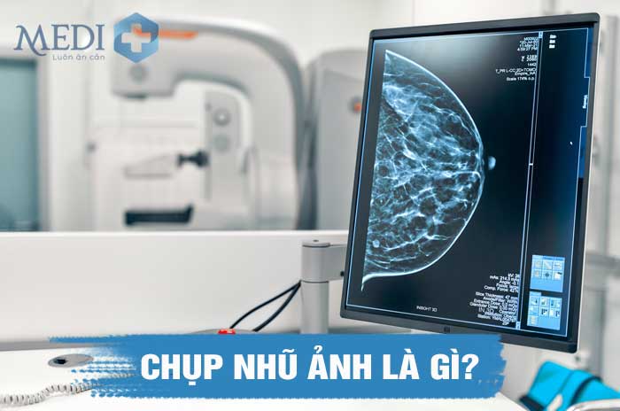 Chụp nhũ ảnh (chụp X quang vú) phát hiện sớm ung thư vú