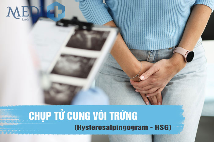 Chụp tử cung vòi trứng