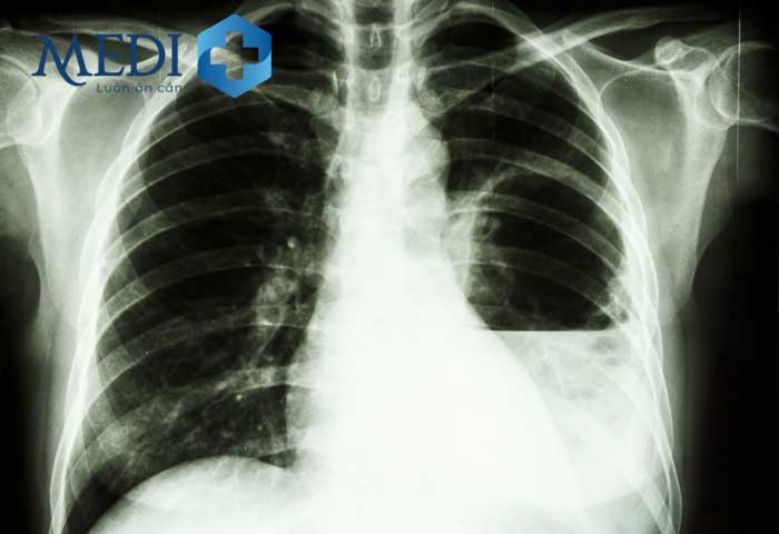Hình ảnh áp xe phổi trên phim X-quang