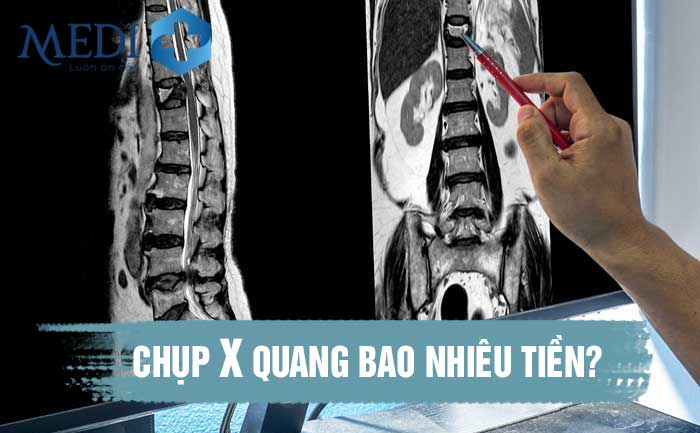 Giá chụp X-quang bao nhiêu tiền, có đắt không?