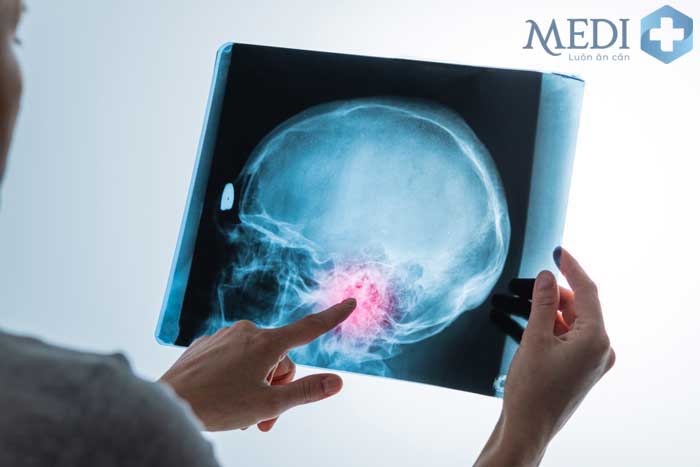 Chụp X quang đầu có phát hiện u não, khi nào thì nên thực hiện?