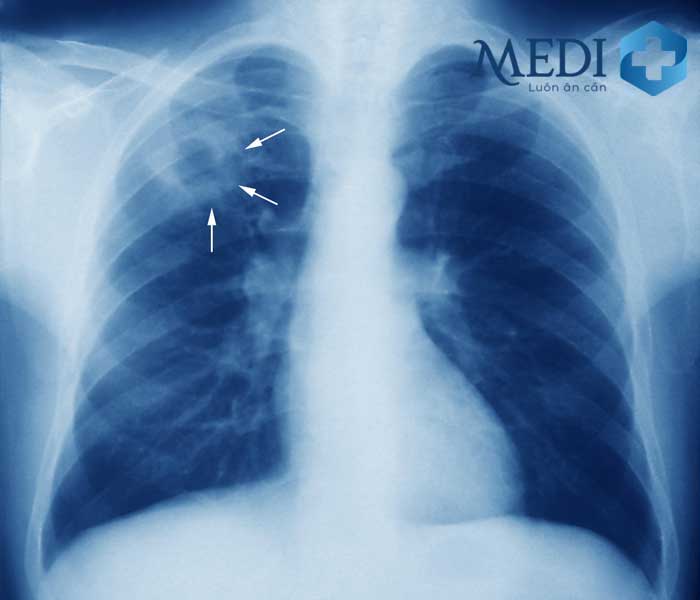 Hình ảnh lao phổi trên phim X-quang