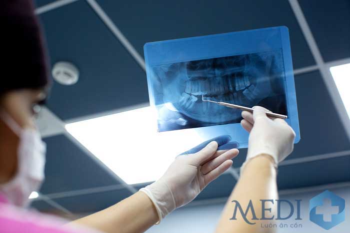 Chụp X quang răng
