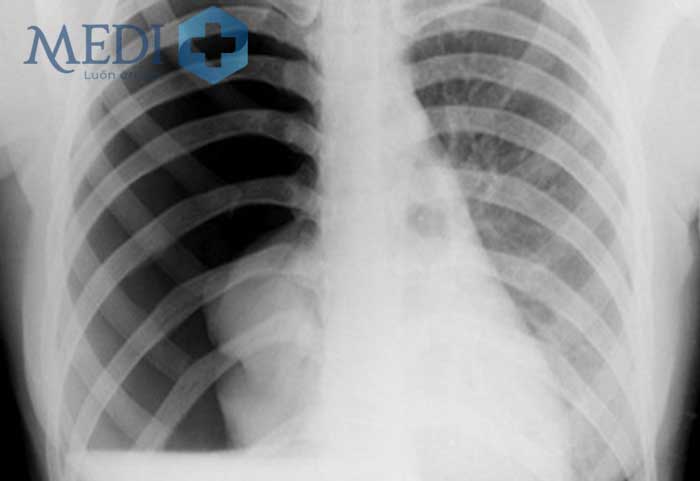 Hình ảnh tràn khí màng phổi trên phim chụp X-quang