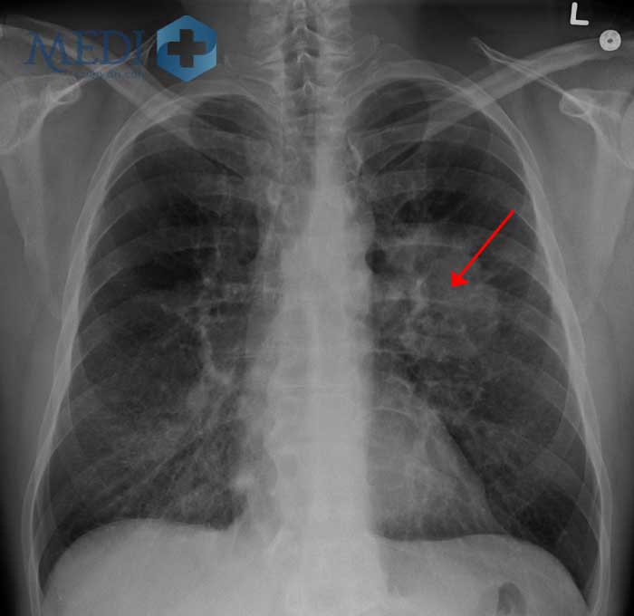Hình ảnh ung thư phổi trên phim X-quang