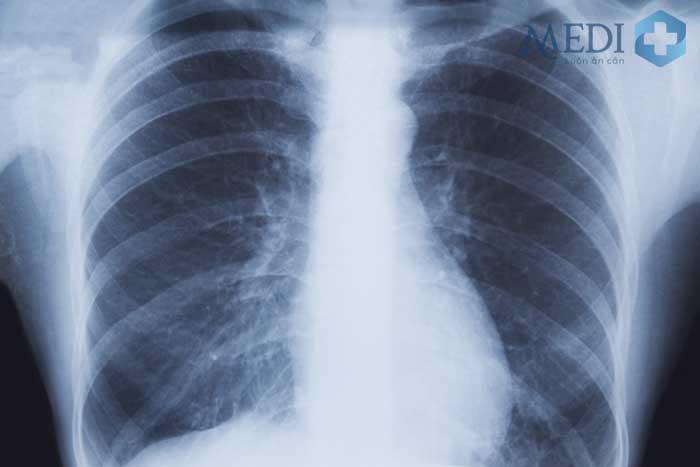 Hình ảnh viêm phổi thùy dưới bên phải trên phim X-quang