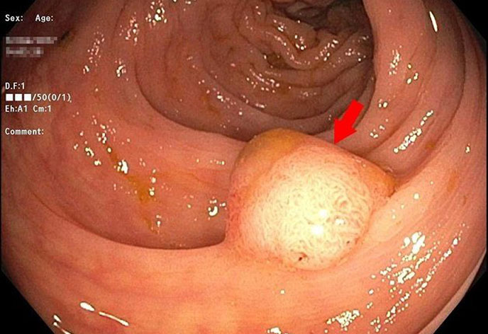 Đại tiện ra máu tươi có thể là dấu hiệu cảnh báo Polyp đại tràng