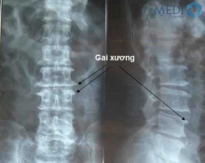 Gai cột sống thắt lưng là nguyên nhân gây đau lưng dưới