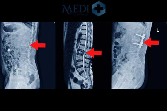 Hẹp ống sống khiến các cơn đau lưng âm ỉ hoặc có thể dữ dội