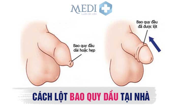 Lột bao quy đầu là gì? Có tự thực hiện tại nhà được không?