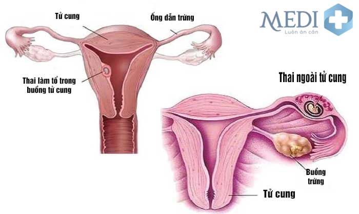 Mang thai ngoài tử cung(chửa ngoài tử cung) có thể gây biến chứng nguy hiểm.