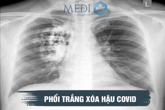 Phổi trắng xóa hậu Covid dù đã khỏi bệnh