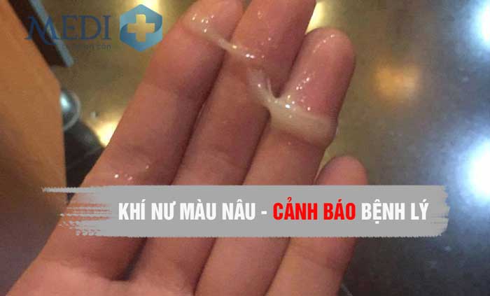 Khí hư màu nâu là bị bệnh gì? Nguyên nhân gây ra khí hư màu nâu