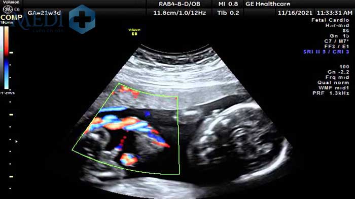 Siêu âm doppler đánh giá sự phát triển của thai