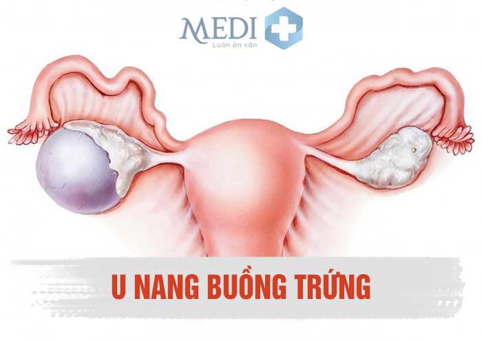 Khối u nang buồng trứng phát triển âm thầm do các mô mới