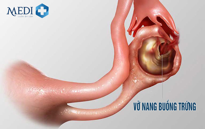 Vỡ nang buồng trứng biến chứng xấu u nang buồng trứng