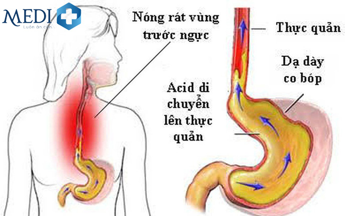 Axit trào ngược lên thực quản gây cảm giác nóng rát, tức ngực