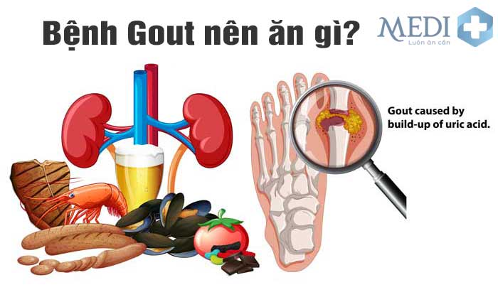 Bệnh gout nên ăn gì kiêng ăn gì