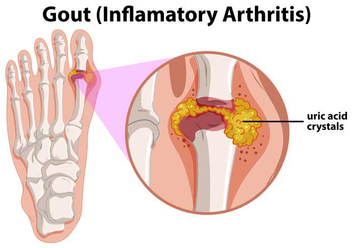 Bệnh gout là gì