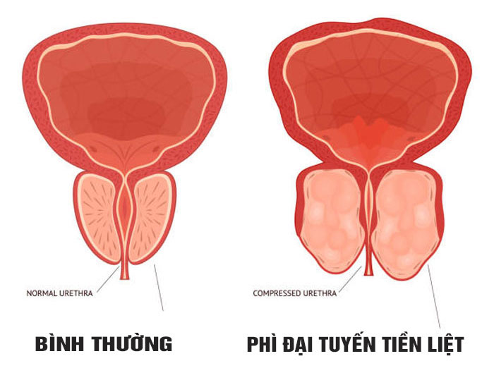 Phì đại tuyến tiền liệt - Căn bệnh "khó nói" của các anh