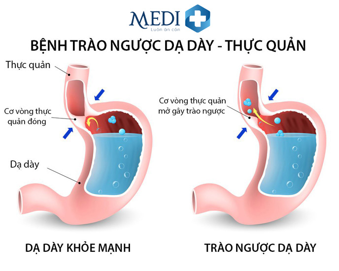 Bệnh trào ngược dạ dày thực quản gây khó chịu và ảnh hưởng tới sức khỏe