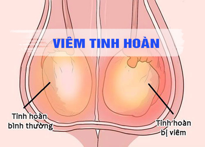 Viêm tinh hoàn nhận biết sớm tránh những tổn thương