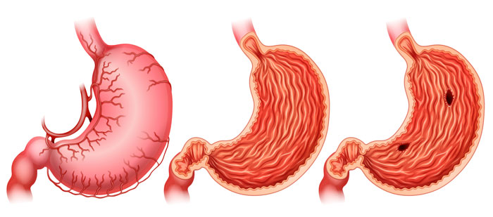 Biến chứng nguy hiểm do hẹp môn vị không phát hiện và điều trị sớm từ giai đoạn đầu