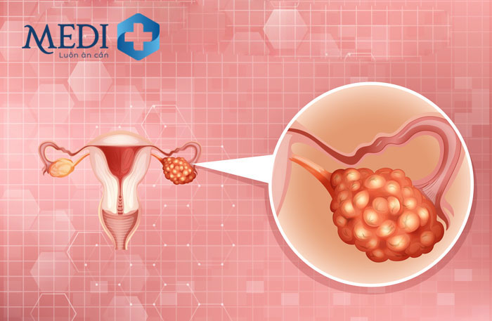 U nang buồng trứng gây rối loạn kinh nguyệt, giảm chức năng sinh sản