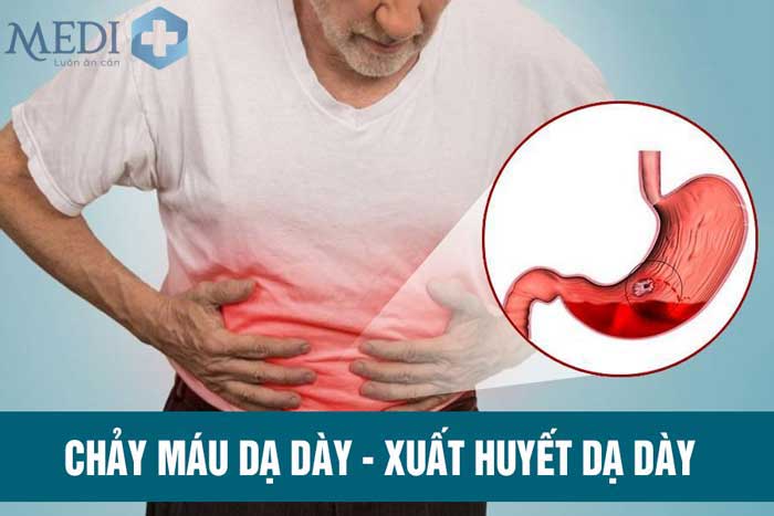 Chảy máu dạ dày (xuất huyết dạ dày) nguyên nhân từ đâu?