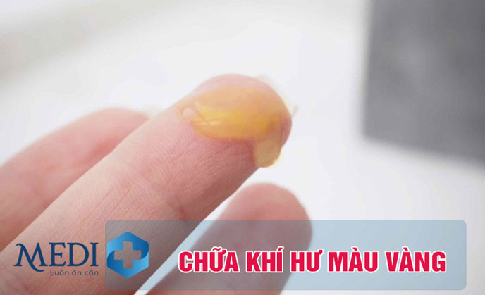 Chữa khí hư màu vàng như thế nào