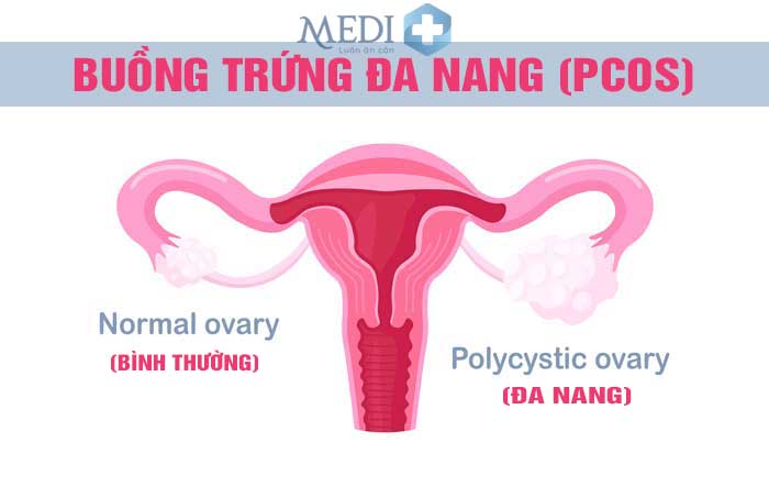 Buồng trứng đa nang (PCOS) nguyên nhân hàng đầu gây vô sinh nữ giới.